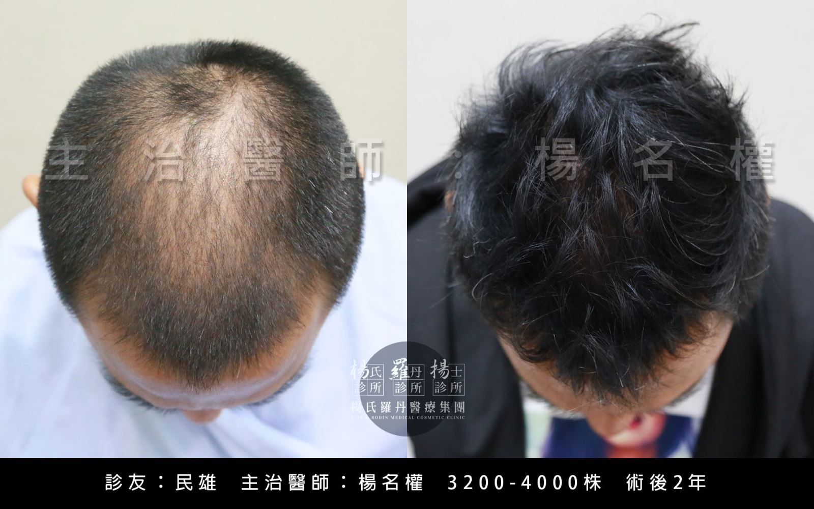 植髮,民雄,禿頭,楊名權 六合一三階段雄性禿治療